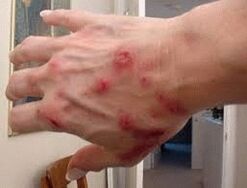 Papules sur la peau avec des helminthiasis