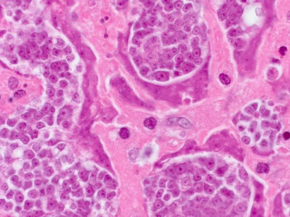 Recherche parasites en une personne